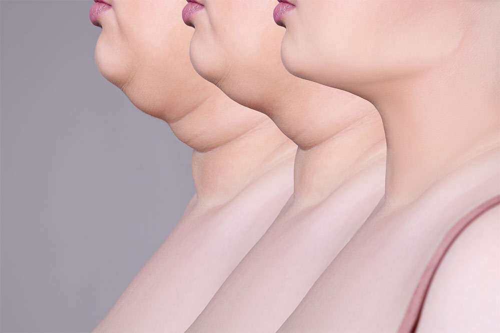 Say Goodbye to Your Double Chin with Kybella!
